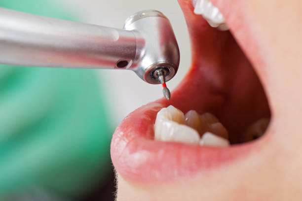 Best Emergency Wisdom Teeth Removal in Town And Country, MO